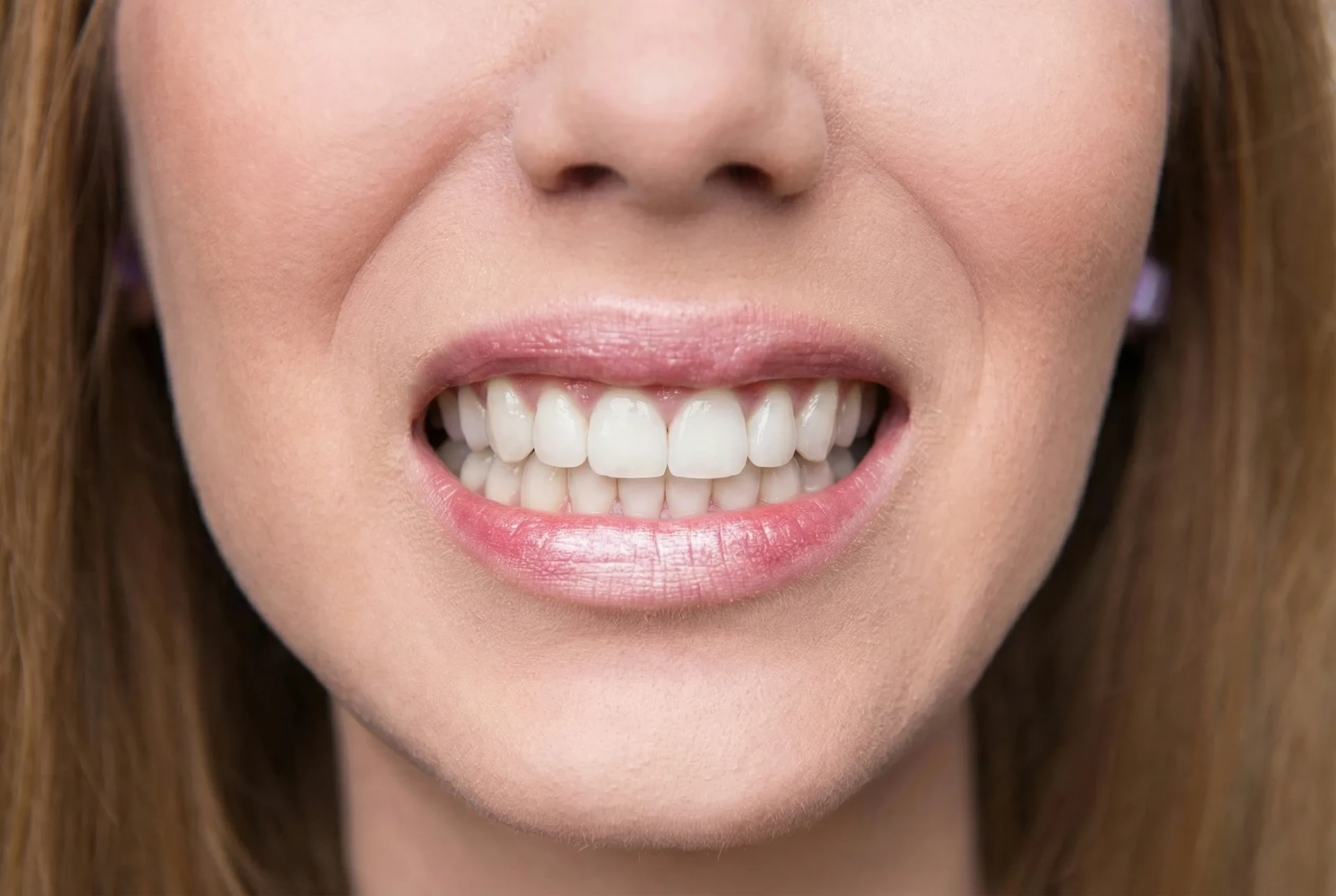 After Invisalign treatment