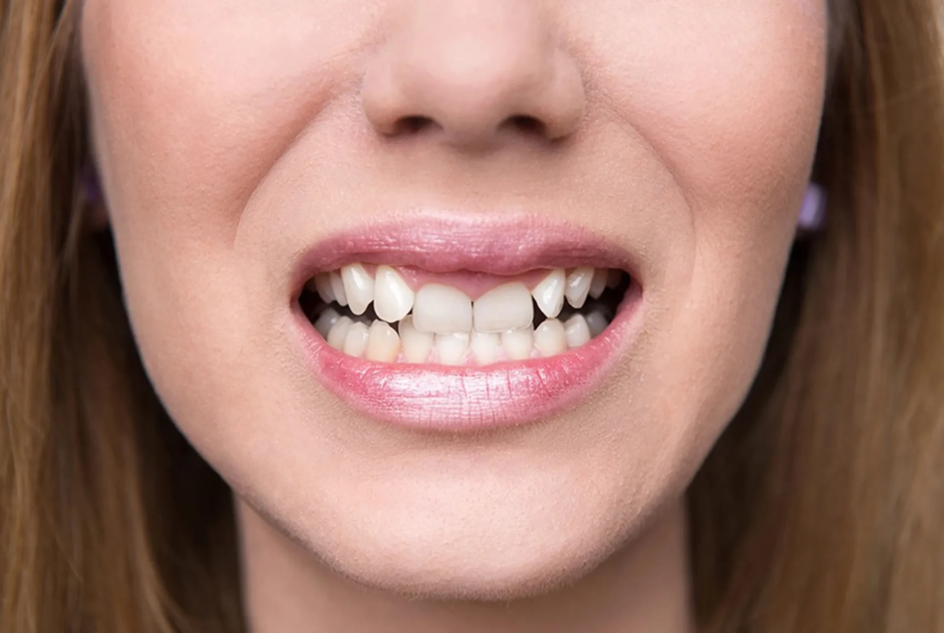 Before Invisalign treatment